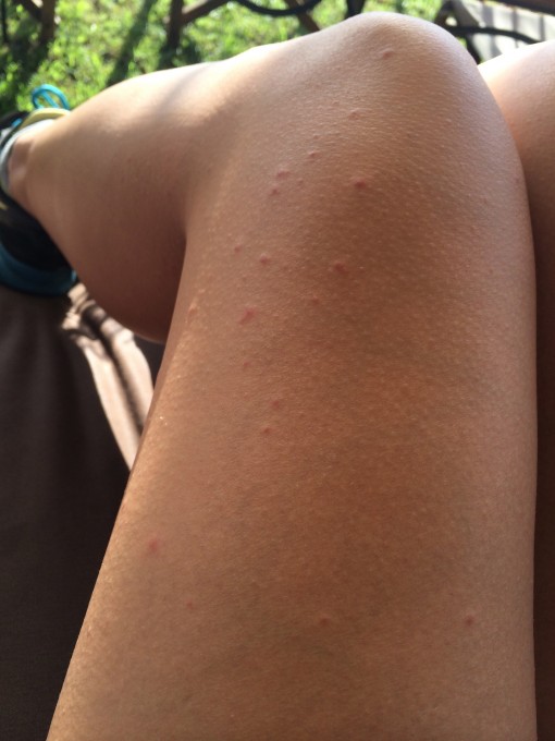 African Mosquito Bites